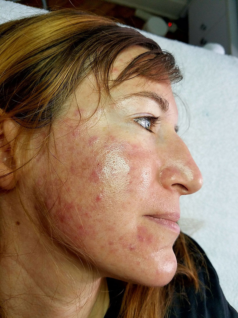 Before-Acne-Treatment