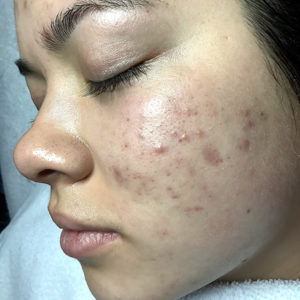 before-acne-treatment