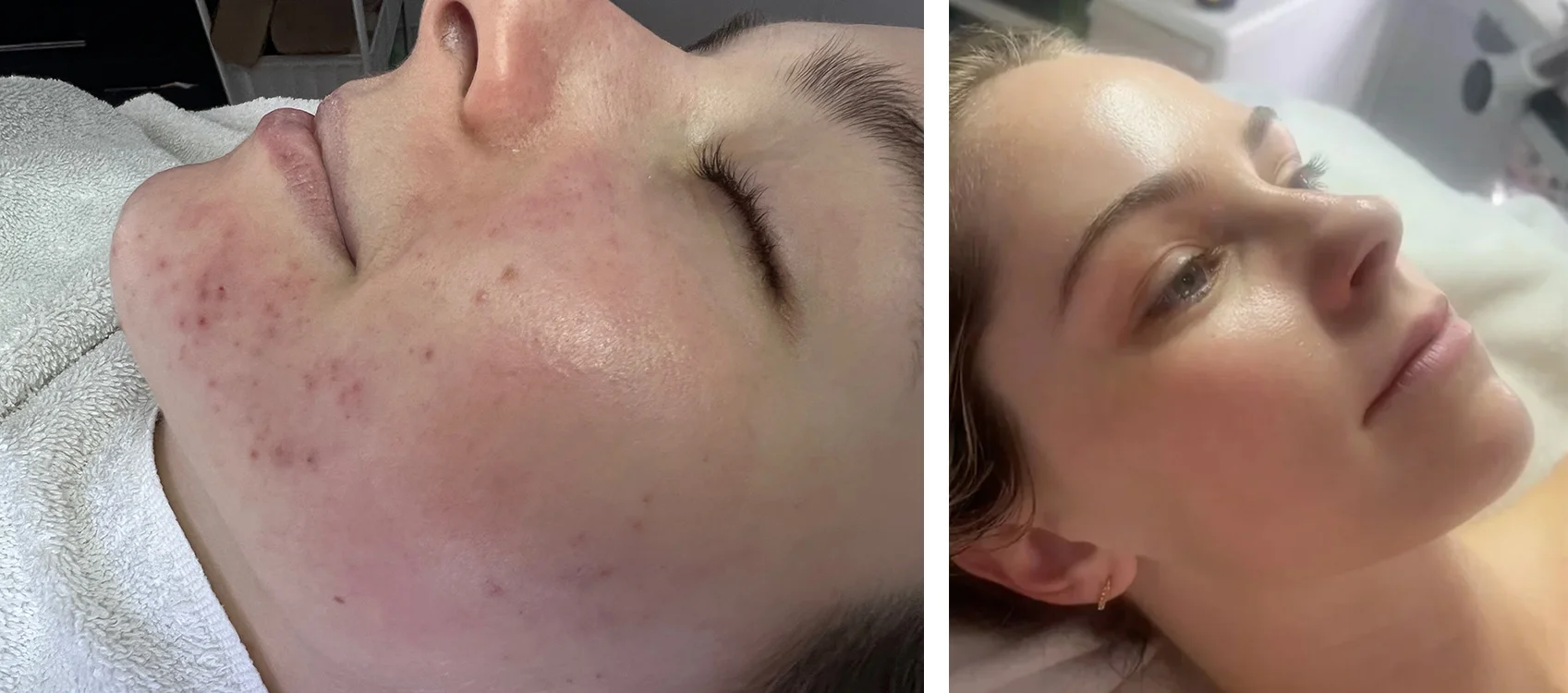 Before-after audra