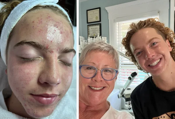 Acne Treatment before